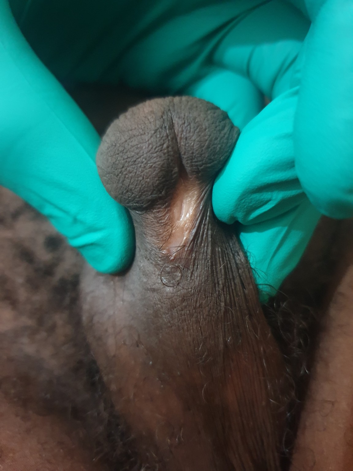 Photographie clinique anonymisée montrant l’ectopie ventrale du méat urétral chez un adulte porteur d’un hypospadias non corrigé